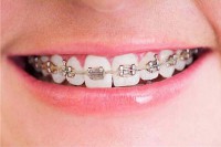 /album/dental-solutions/ortodoncia-infantil-jpg/