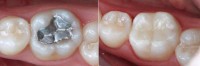 /album/dental-solutions/empastes-jpg/