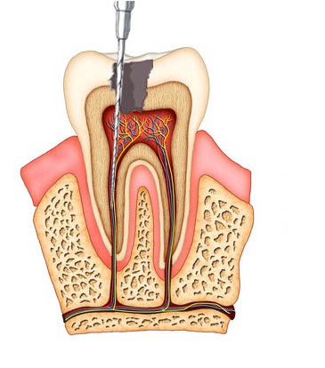 Endodoncia