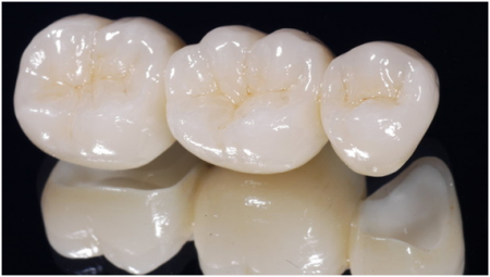 Protesis Dental